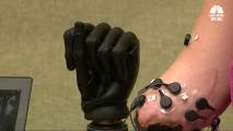 Mom Bitten by Shark Gets High-Tech Prosthetic Arm