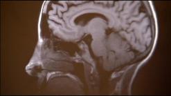 Preventing Kids Concussions