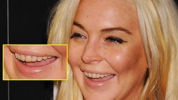 lindsay-lohan-teeth-722