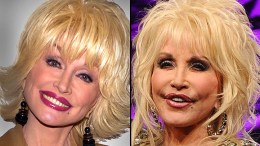 Plastic Surgery: Celebrities Then and Now