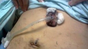 TSA Accused of Fiddling with Feeding Tube
