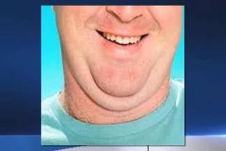 New Drug Could Eliminate Double Chins