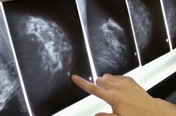 New Breast Cancer Recommendation Baffles Women