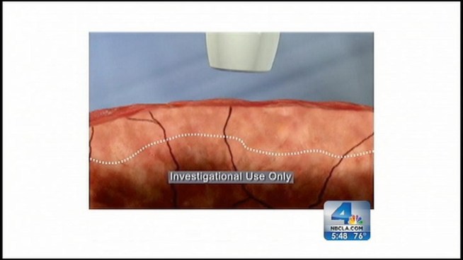 If approved by the FDA, a new device called MarginProbe will be available for use around the country to help breast cancer patients avoid repeat surgeries. The handheld tool uses electromagnetic waves to detect possible cancerous cells that might be invisible to the naked eye. Dr. Bruce Hensel reports for the NBC4 News at 5 p.m. on Oct. 30, 2012.