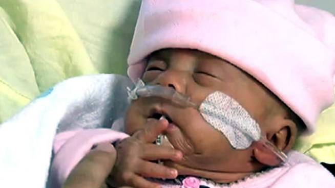 Third-Smallest Baby Ever Born Doing Well