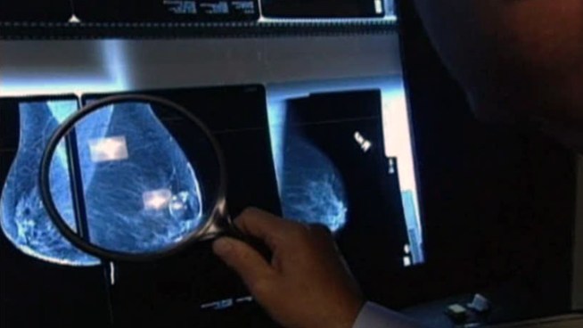 Kimberly Chandler lost her right breast to breast cancer, and surgery and radiation left her skin unable to go through a breast implant procedure. Chandler turned to a new treatment that uses a patient's own stem cells to help repair and restore breasts damaged by surgery and radiation. Dr. Bruce Hensel reports for the NBC4 News at 5 p.m. on June 13, 2012.