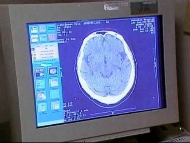 3D Images of Brain Aneurysms Save Lives