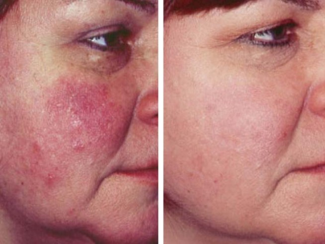 New Acne Medication Approved