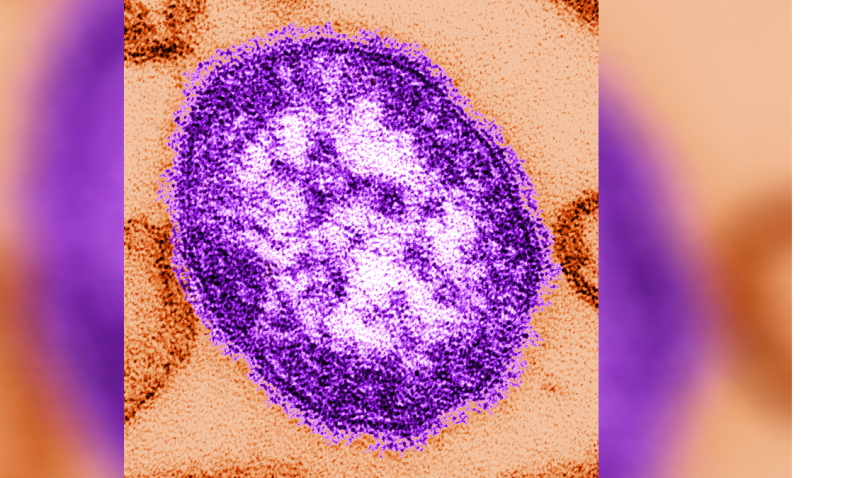 Measles-outbreak-Los-Angeles-4-29-19