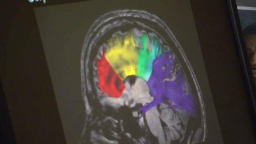 Scientists_Announce_Breakthrough_on_CTE.jpg