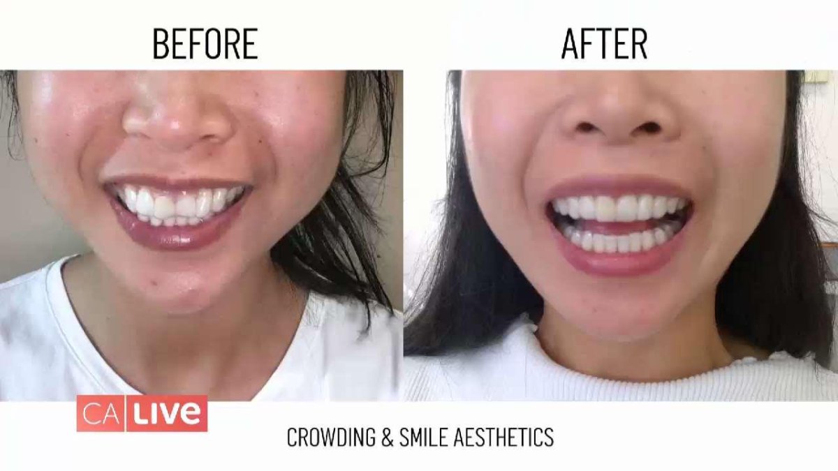 Smile More With Uniform Teeth (Sponsored) NBC Los Angeles