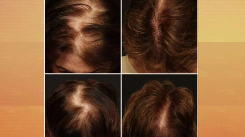 There S A Solution For Younger Women With Thinning Hair Nbc Los