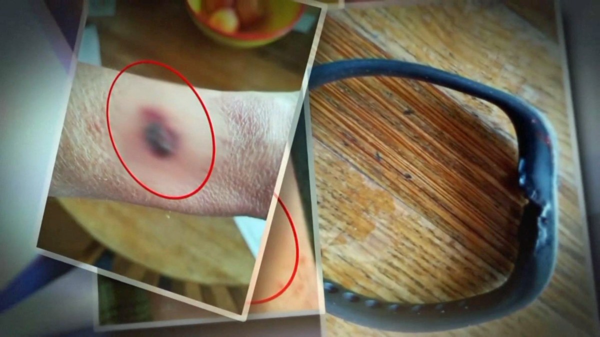 fitbit burning wrist