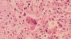 Measles identified in traveler who passed through LAX