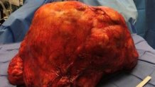 tumor-hernandez-usc-121418