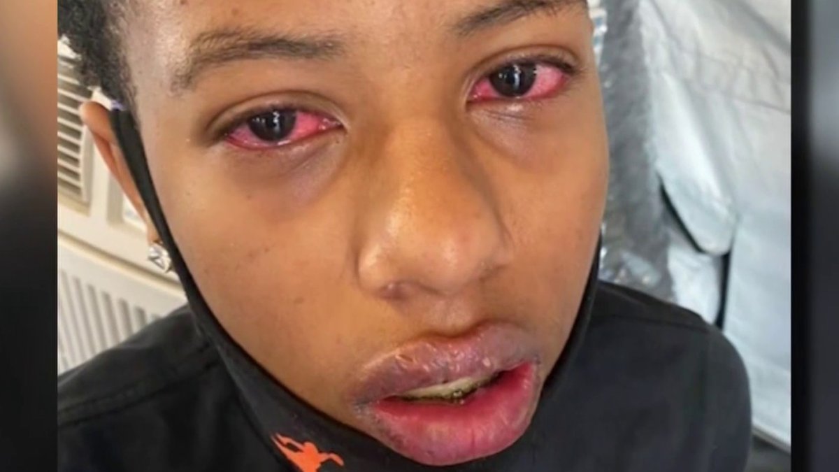 mis c lips Mucocutaneous Findings in MIS-C 35 children (NYC) w/ MIS-C, 83% w/  mucocutaneous sx. Conjunctival injection, palmoplantar erythema, lip  hyperemia, periorbital erythema/edema, strawberry tongue, and malar  erythema most common. https://t.co/tVIuAVzJNX main image 0