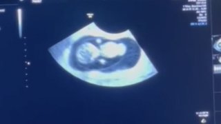 Ultrasound image of fetus