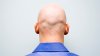 One Molecule May Be the Key to Whether or Not You Lose Your Hair, UCI Study Finds