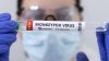 Orange County Confirms First Presumptive Monkeypox Case