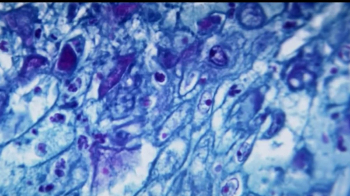 Presumptive Case of Monkeypox Reported in Long Beach – NBC Los Angeles