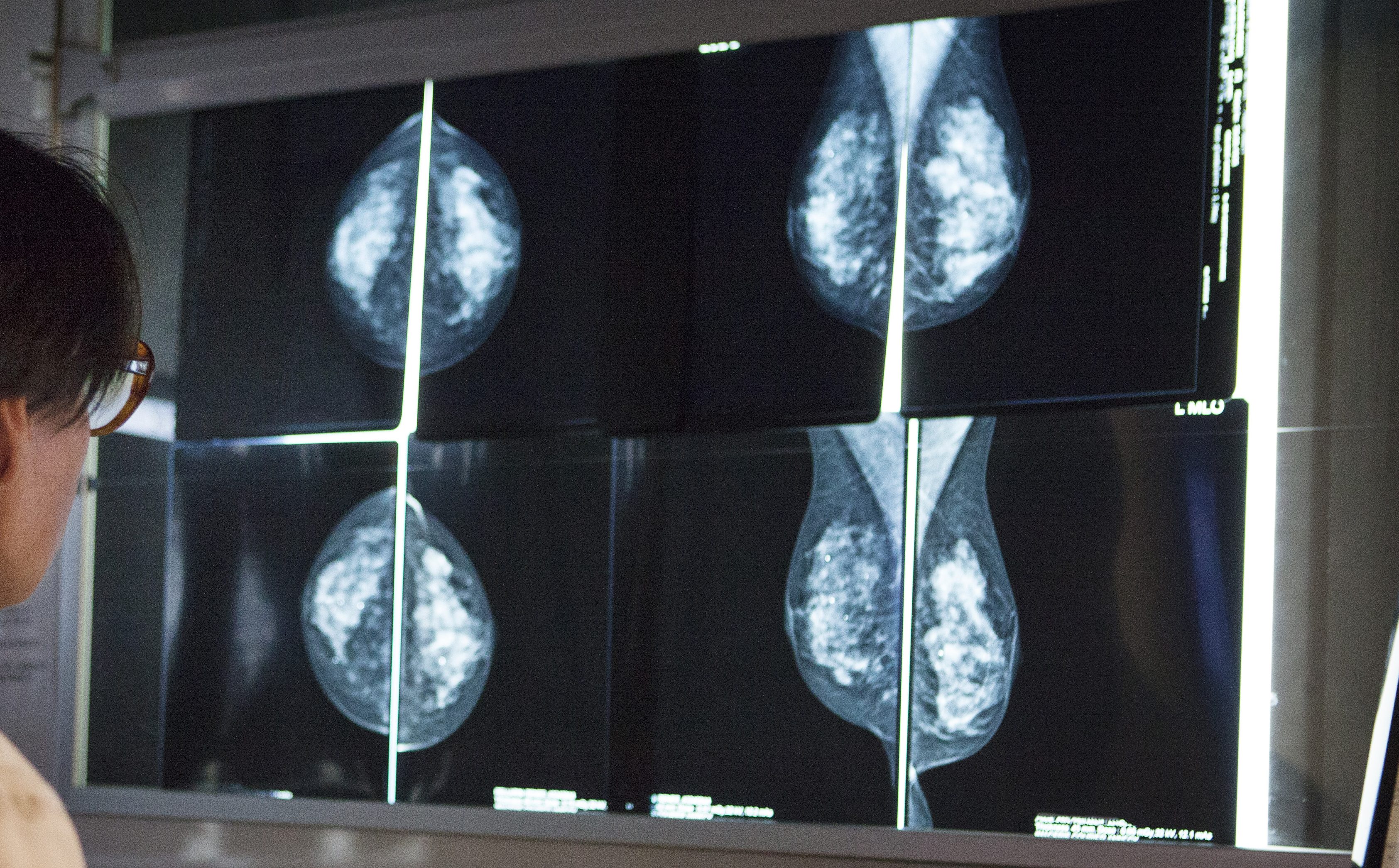 What Does it Mean to Have Stage 1A Breast Cancer? – NBC Los Angeles - Vimarsana News