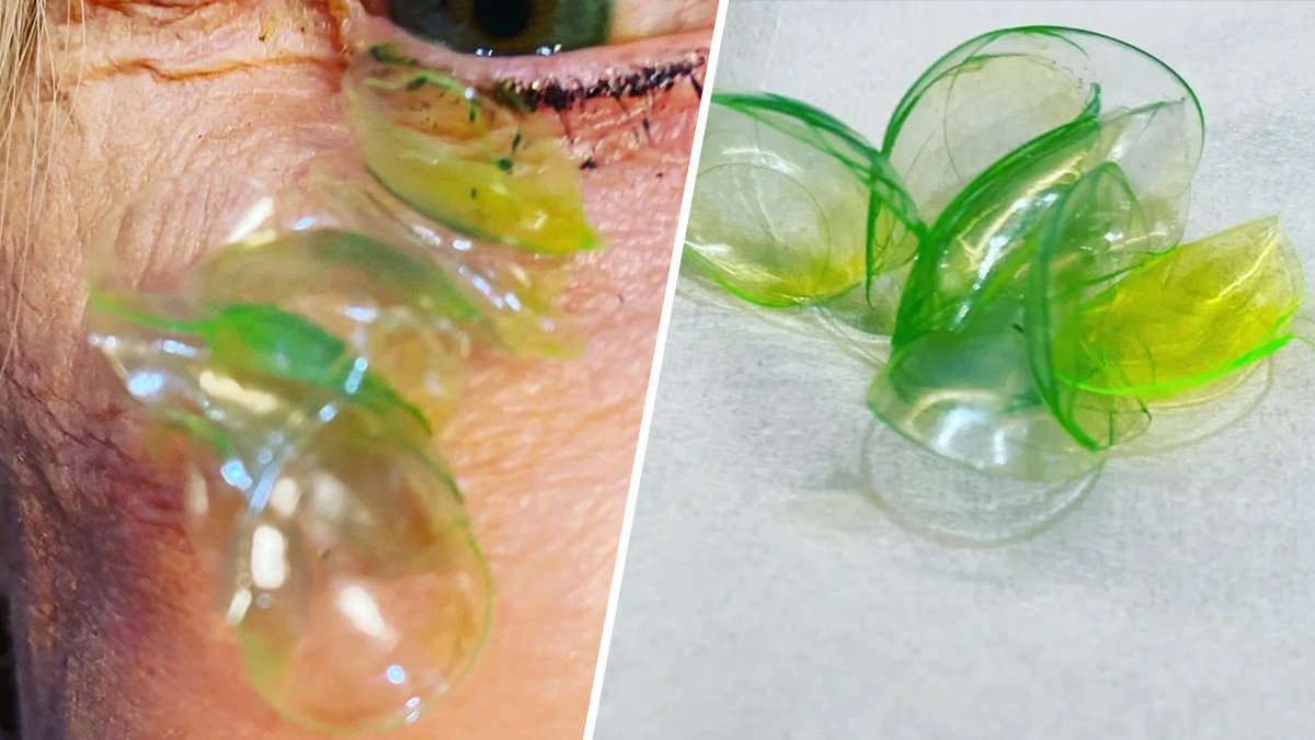 Woman Had 23 Contact Lenses Stuck Under Her Eyelid, Doctor Says – NBC Los Angeles - Vimarsana News