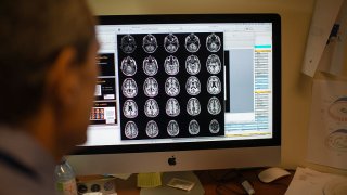 Alzheimer’s is the most common form of dementia, a general term for loss of memory, language, and other thinking abilities