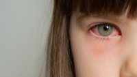 Most kids get antibiotics for pink eye, study shows. Experts say they're usually not needed
