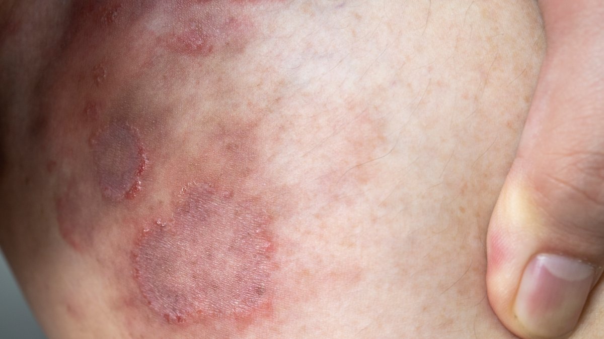 First Resistant Ringworm Infections Detected in United States – NBC Los Angeles - Vimarsana News
