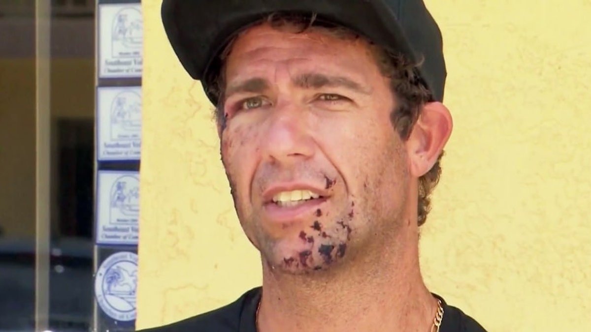 Surfer recalls getting bit in the face by shark at Florida beach – NBC Los Angeles - Vimarsana News