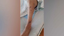 Rodrigo Constain was bit in the leg by a crocodile