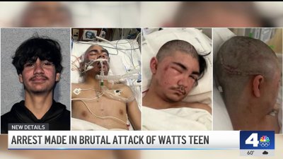 Teen victim of brutal assault undergoes second surgery