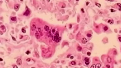 Possible measles exposure at LAX