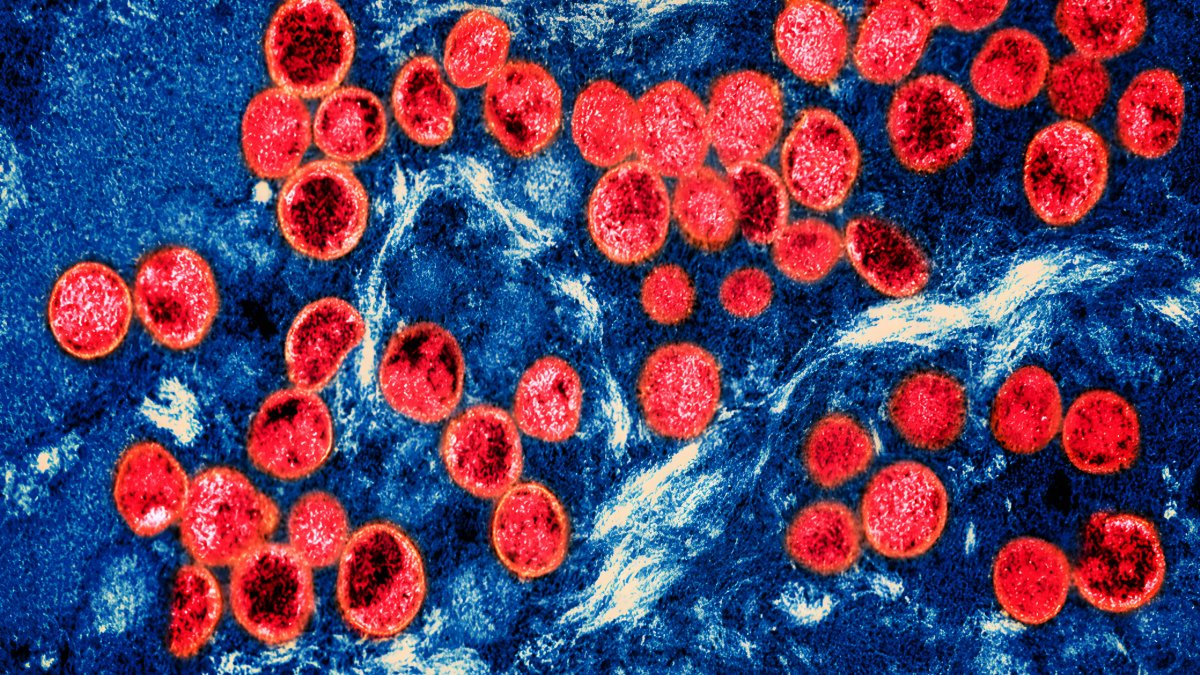 Mpox cases surge in Los Angeles County Los Angeles County reports rise in Mpox cases – NBC Los Angeles Mpox cases surge in Los Angeles County Los Angeles County reports rise in Mpox cases – NBC Los Angeles