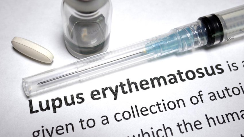 Lupus erythematous