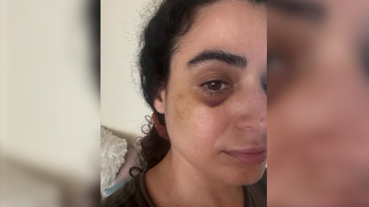 ‘I lost several layers of skin.’ Woman attacked by stranger while walking her dog in Fairfax