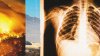 California could face another record-breaking year of Valley fever fungal infection