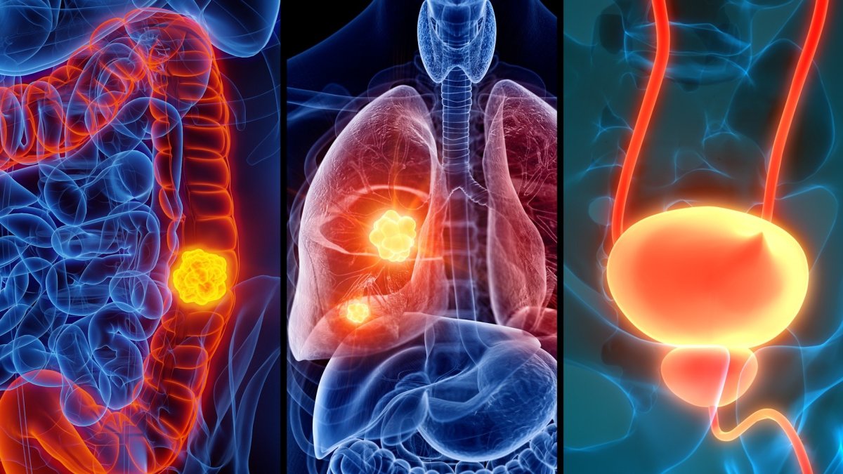 Watch Dr. Kamal list the three most important cancer screenings for men ...