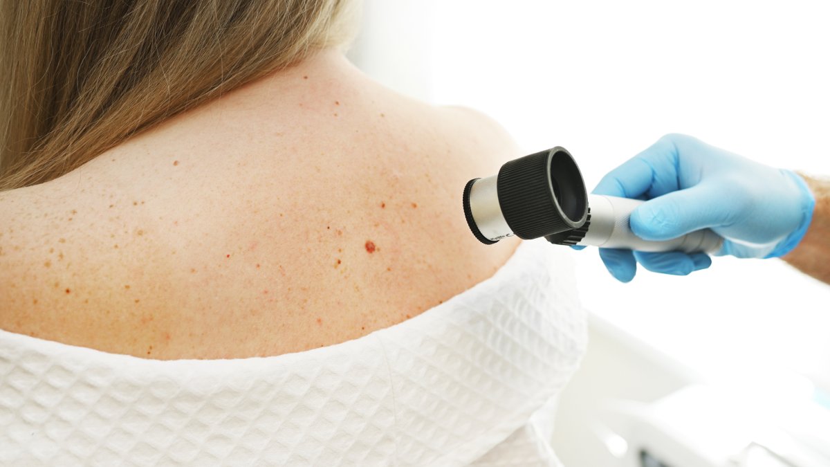 How a dermatologist monitors herself for skin cancer and the ‘big sign’ a mole may be melanoma