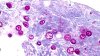 Cyclosporiasis outbreaks: What to know about the foodborne illness and symptoms