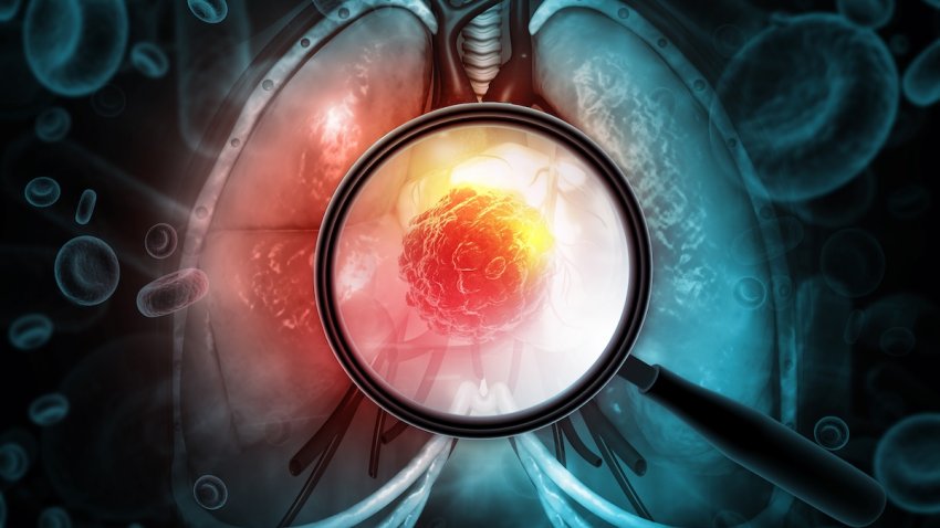A medical illustration of a magnifying glass highlighting a malignant tumor within human lungs, emphasizing early oncological detection and respiratory pathology. 3d illustration