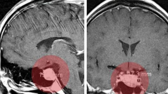 The Supplement That Helped a Doctor With His Brain Tumor
