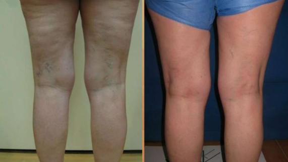 Tuesdays With Dr. Tess: Get Rid of Those Spider Veins