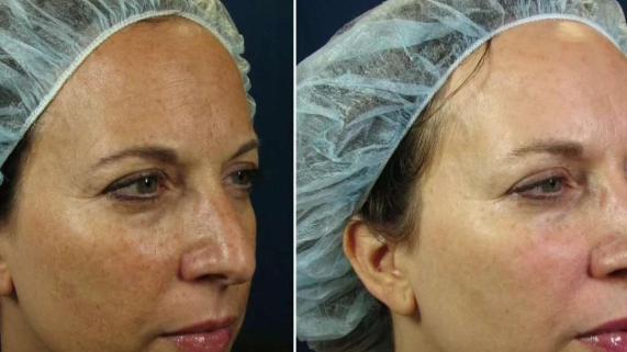 Tuesdays with Dr. Tess: Get Rid of Pesky Dark Spots