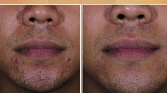 Tuesdays with Dr. Tess: Personalized Acne Treatment