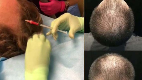 Hair Today, Gone Tomorrow. Doctors Detail a New Procedure