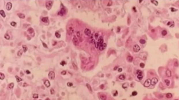 [LA]    Three new cases of measles confirmed in SoCal